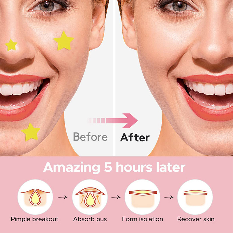 600 PCS/Set Star Pimple Patch  - Beauty Makeup Remover review and price